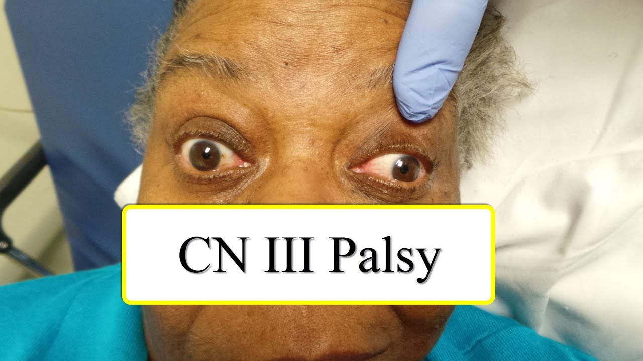 CN III Palsy