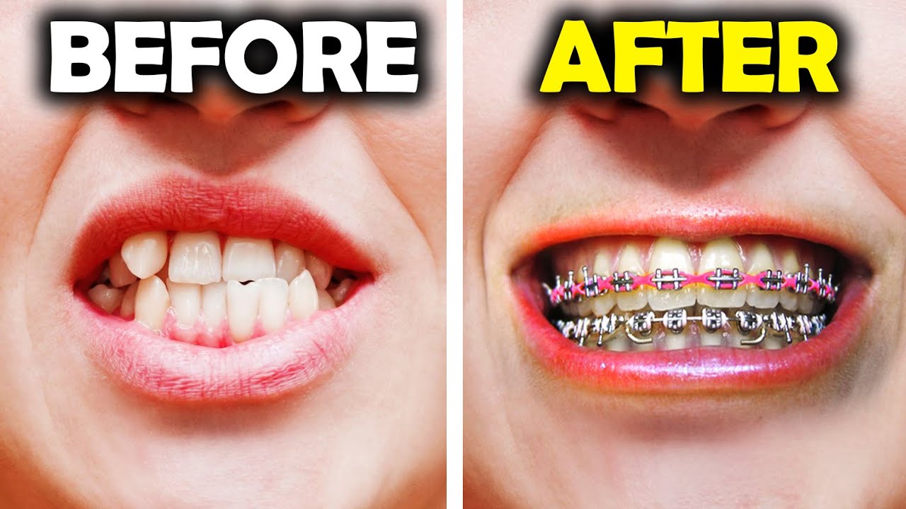 GETTING BRACES - Power Chain