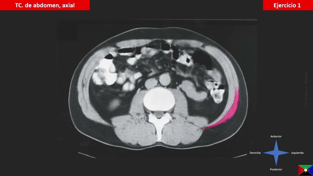Músculos de la pared abdominal mediante tomografía computada