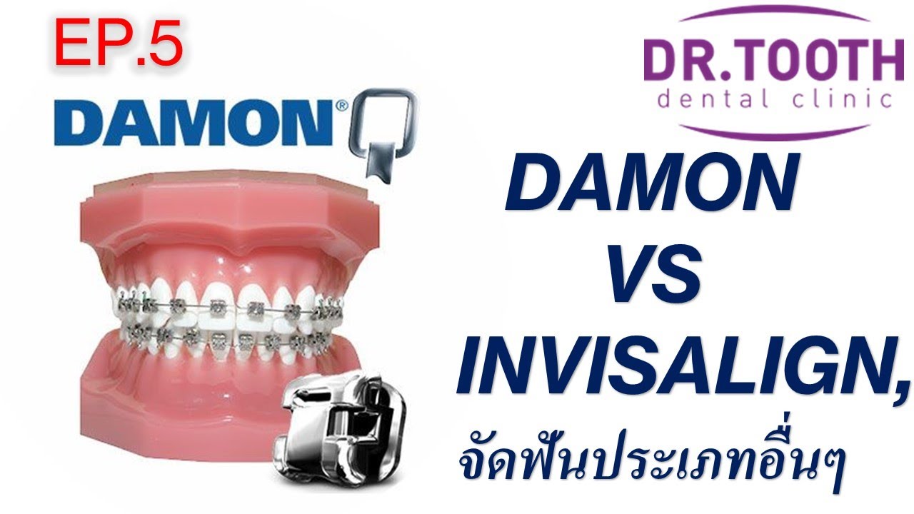 ไขข้อสงสัย, การจัดฟันแบบเดม่อน (DAMON) กับการจัดฟันใส, Invisalign  แบบไหนจะดีกว่ากัน  EP. 5