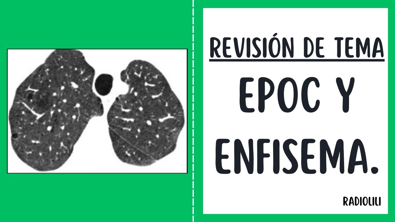 Revisión de Tema 57: EPOC y enfisema.