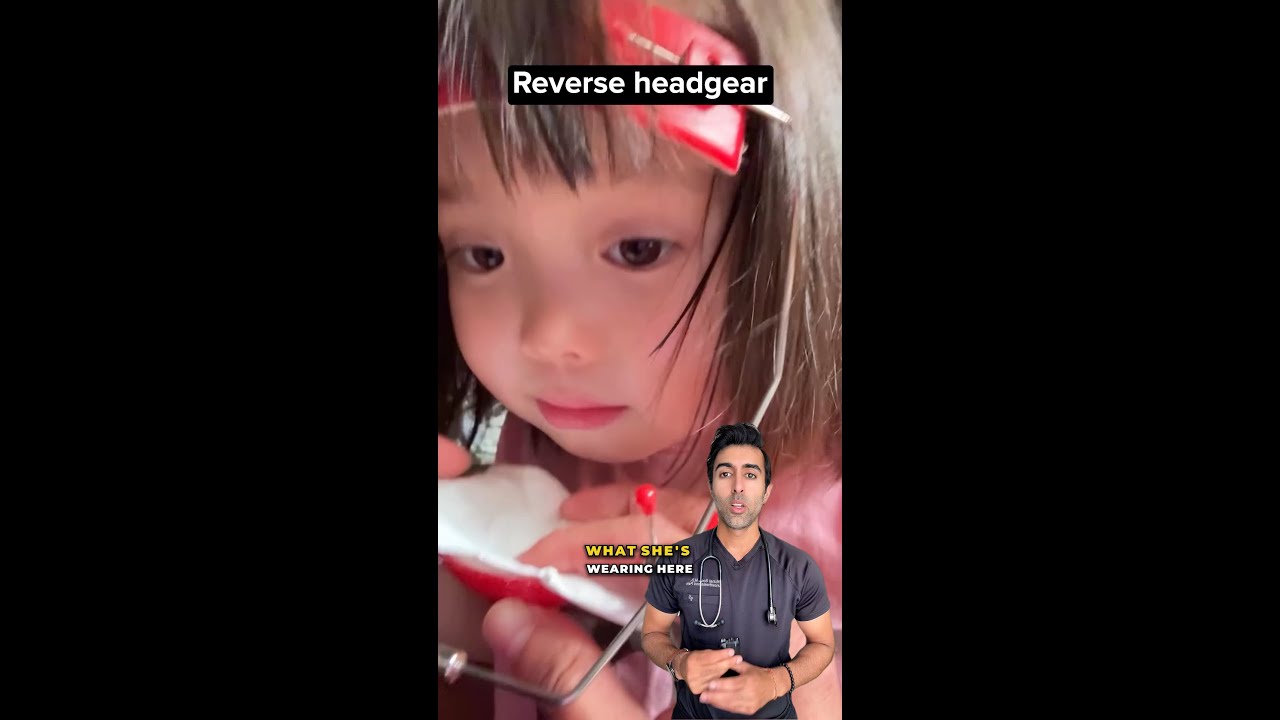 Reverse Headgear for Underbites: How a Protraction Facemask Works