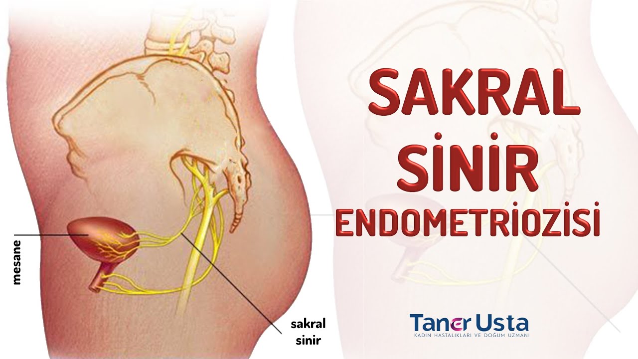 Sakral Sinir Endometriozisi | Prof. Dr. Taner Usta