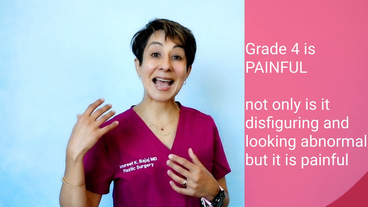 What is Capsular Contracture?
