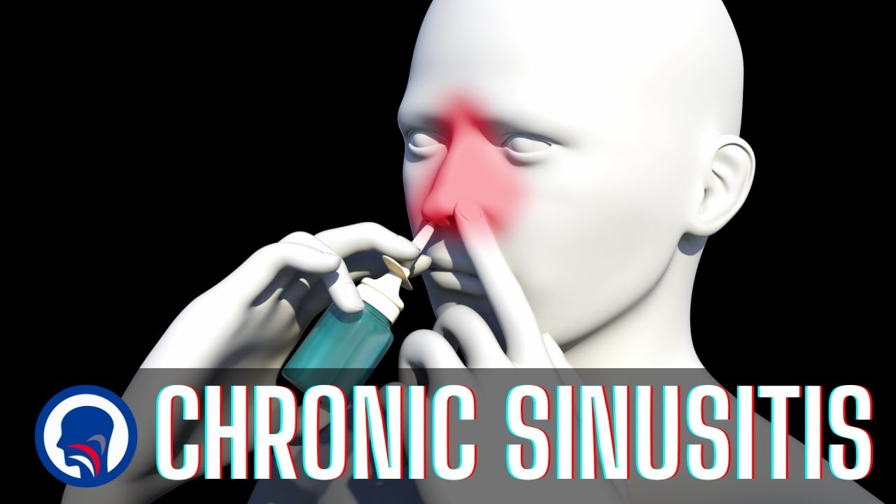 Chronic Sinusitis Q & A | Capital ENT & Sinus Center