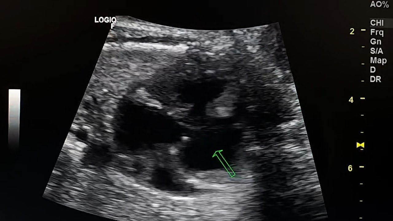 fetal ultrasound shows tricuspid atresia