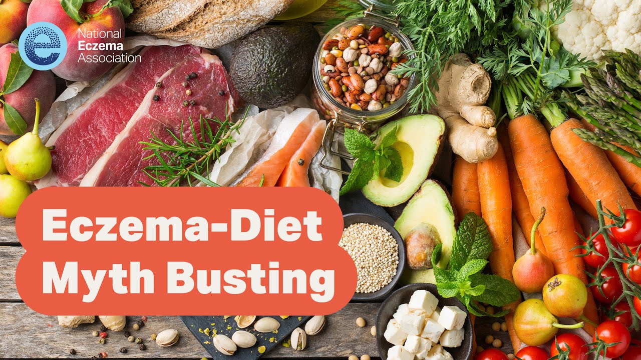 Eczema-Diet Myth Busting
