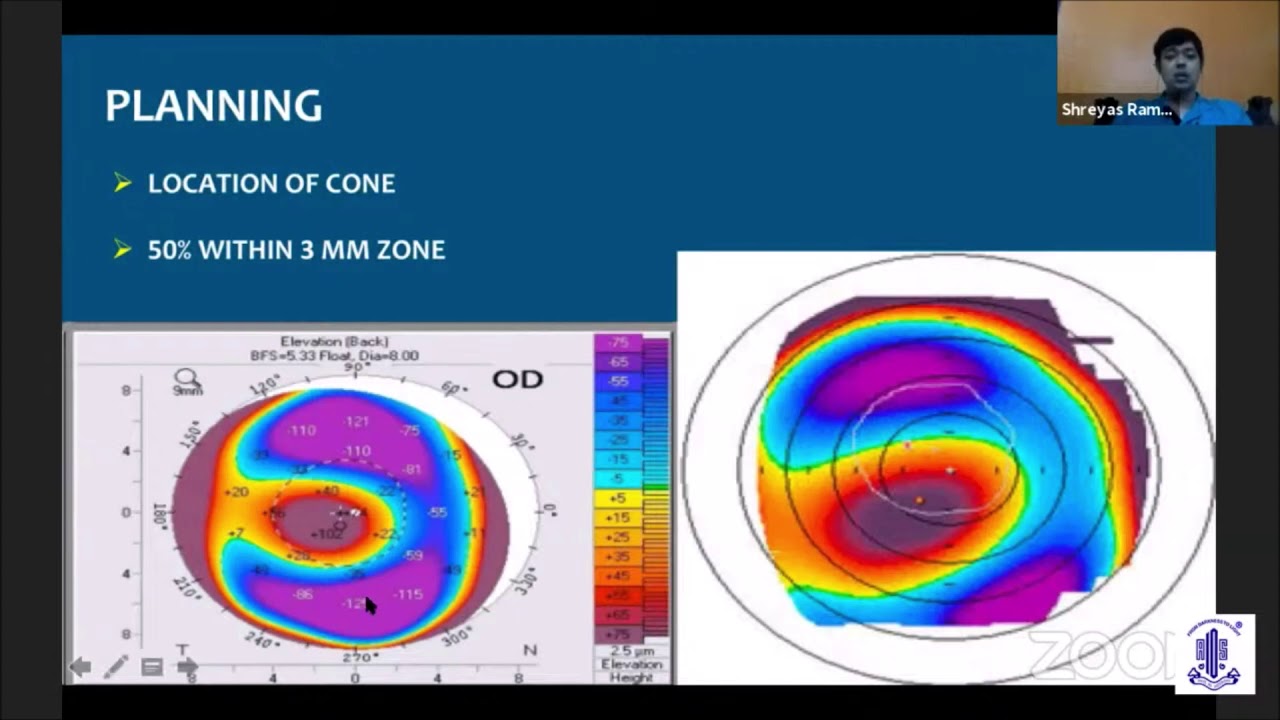 Dr Shreyas Ramamurthy-Intra Corneal Ring Segments-PG Update Series on Refractive Surgeries AIOS ARC