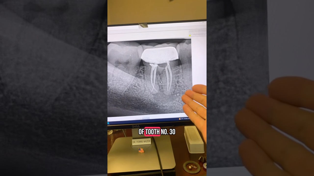 Why did this root canal fail? #dentists #dentist #rootcanal #dentalprosthesis #dentalesthetics