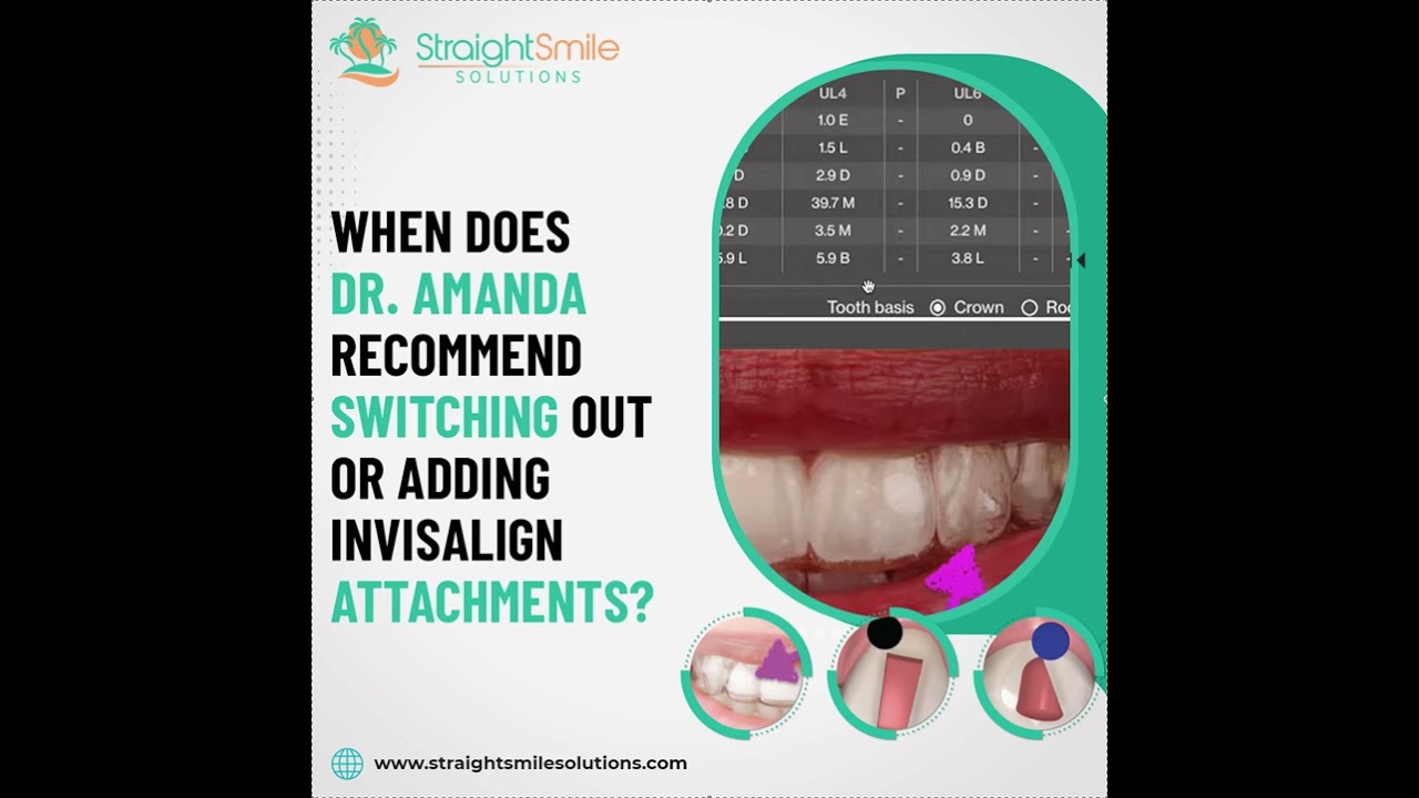 Invisalign Attachments- Changing them Out