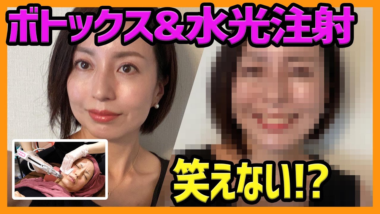 【美容クリニック】水光注射、ボトックス。辛すぎる1週間。