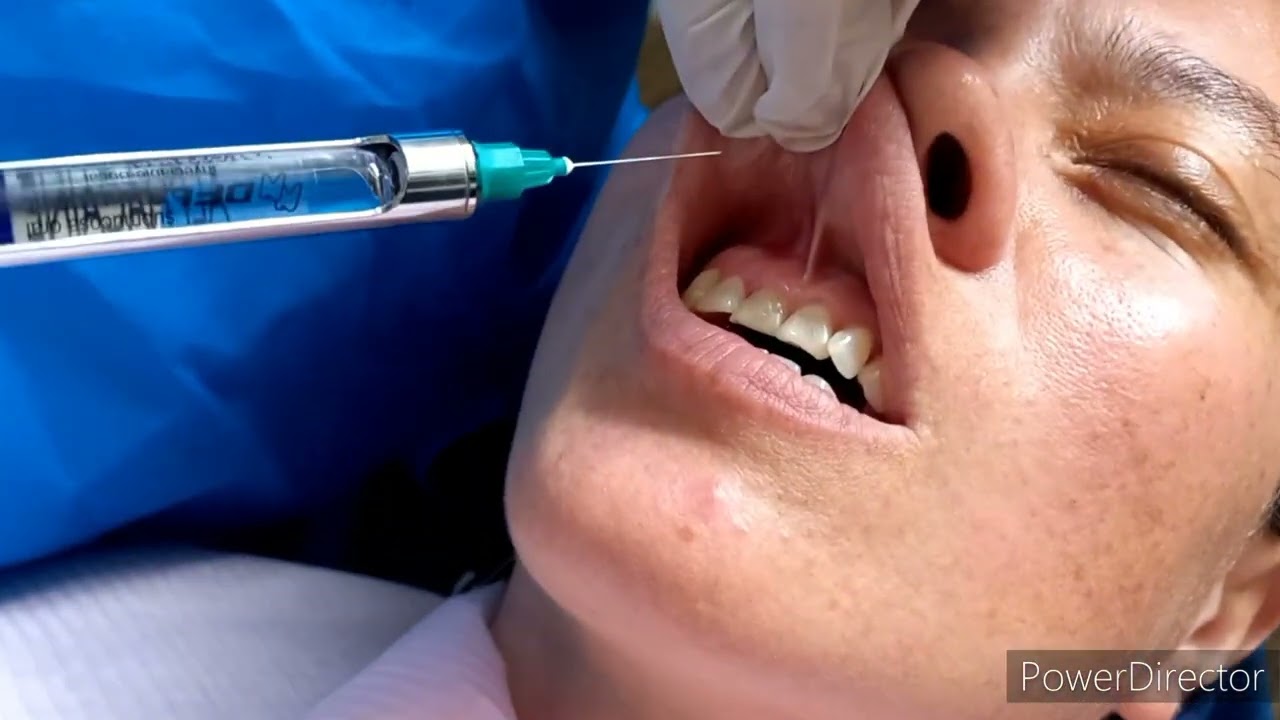 Anestesia t&eacute;cnica Infiltrativa