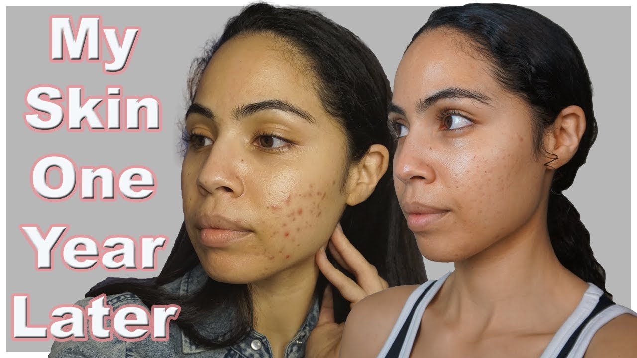 Acne Update - I Listened to My Gut and Cleared My Skin Naturally