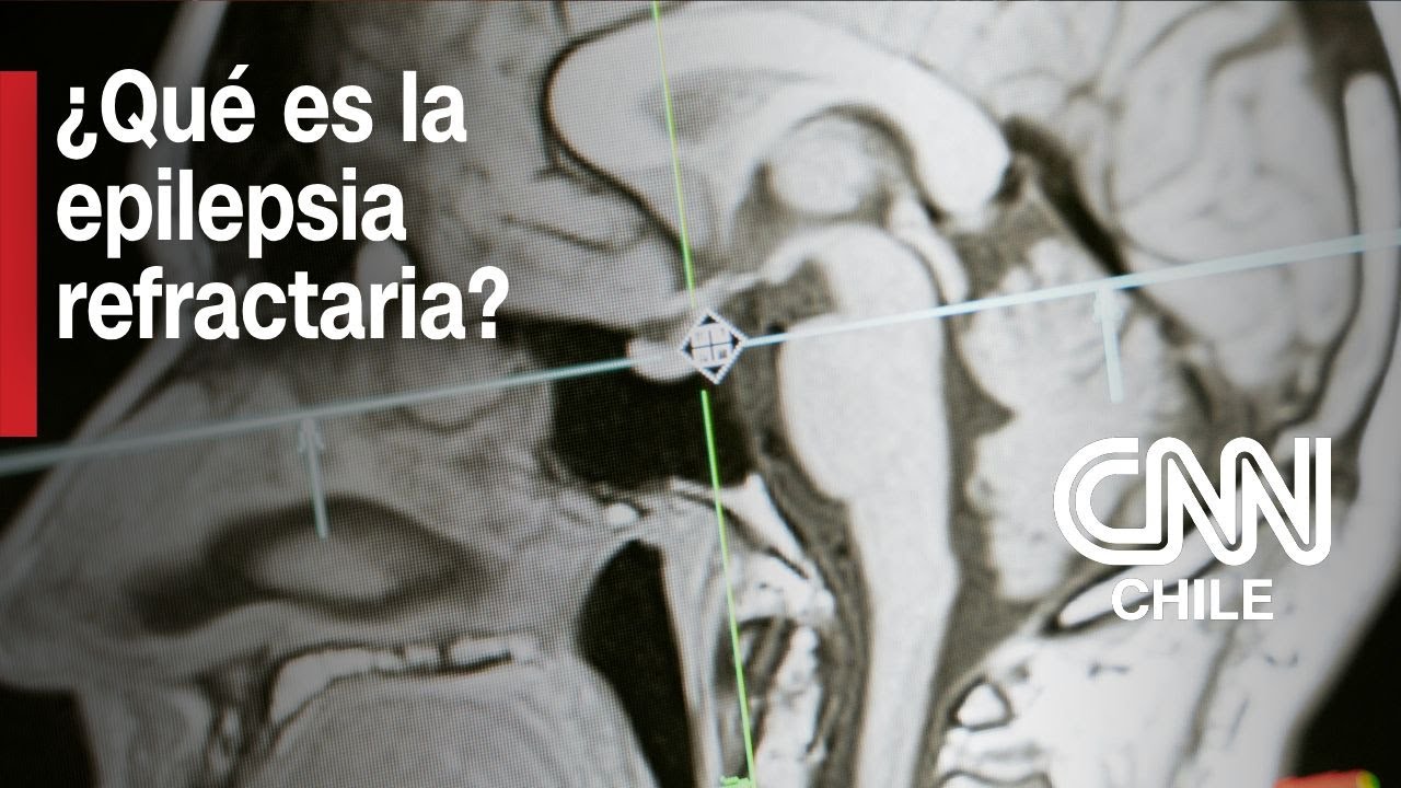Neurólogo da detalles: ¿Qué es la epilepsia refractaria y en qué consiste la cirugía para tratarla?