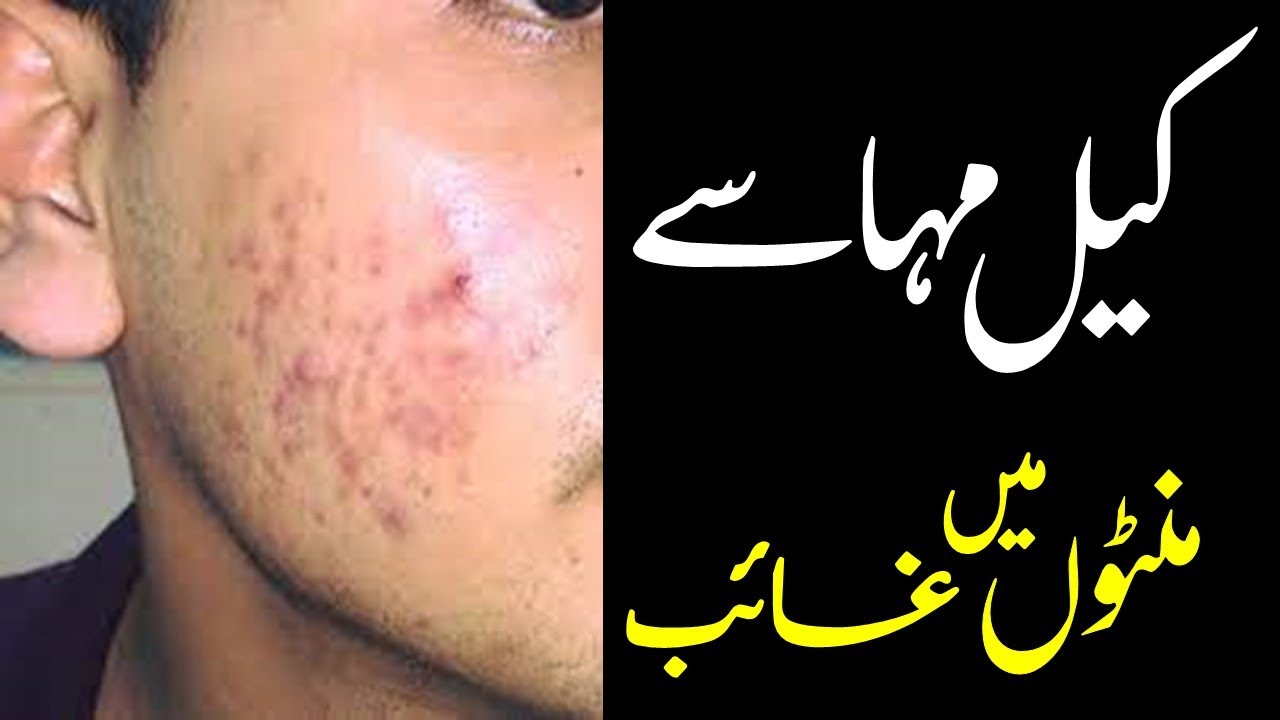 Keel Mahason (Acne & Pimples) Ka Ilaj | Tibe Ahlebait (Part 28) | Maulana Syed Ali Naqi Kazmi