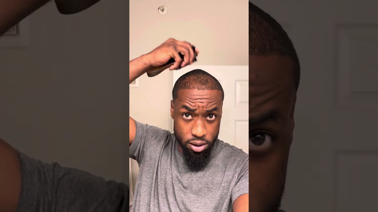 5 month Hair Transplant Update | Afro Hair | HealDone