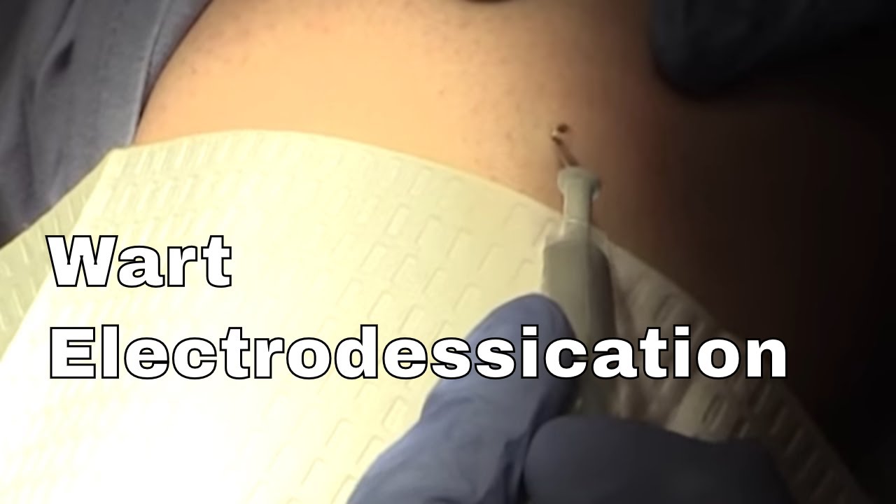 Wart Removal with Dr. Timothy Jochen