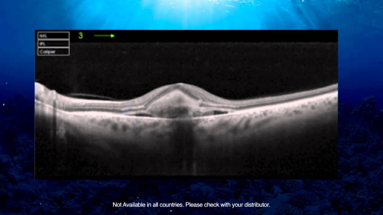 Topcon Swept Source OCT by Prof. Paulo Stanga