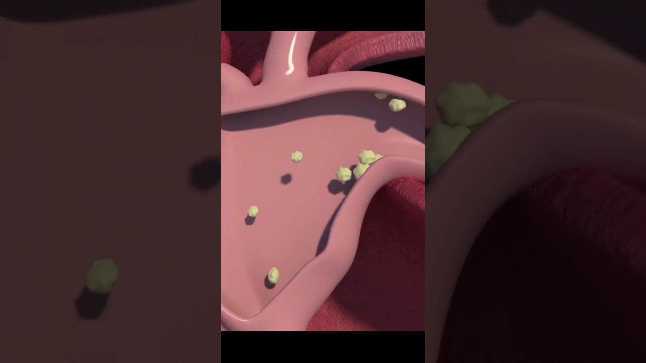 This is What Kidney Stones Look Like