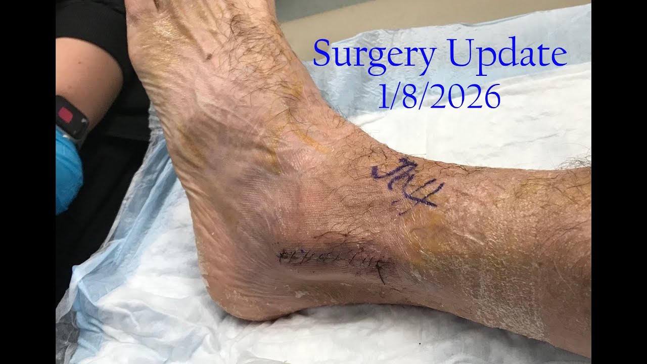 Broken Tibia / Fibula Hardware Removal Update