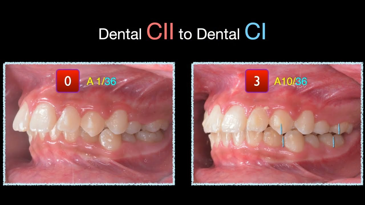 CII Tx with Aligner：Mandibular Advancement Part1｜【Chris Chang Ortho】CC626