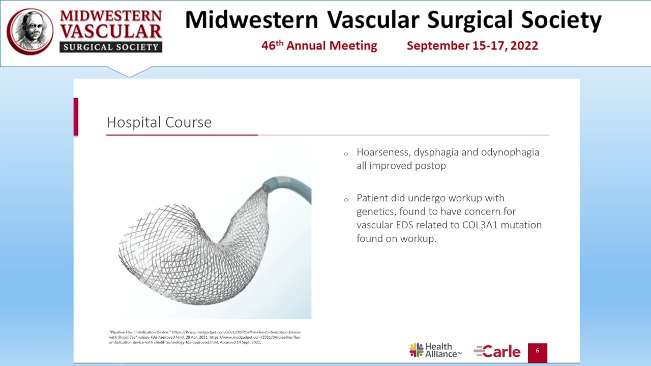 Treatment of an Extracranial Carotid Aneurysm with Flow Diverter Stents and Coil Embolization