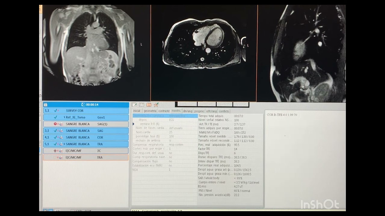 RM CARDIACA. Primeros pasos. Función cardiaca.