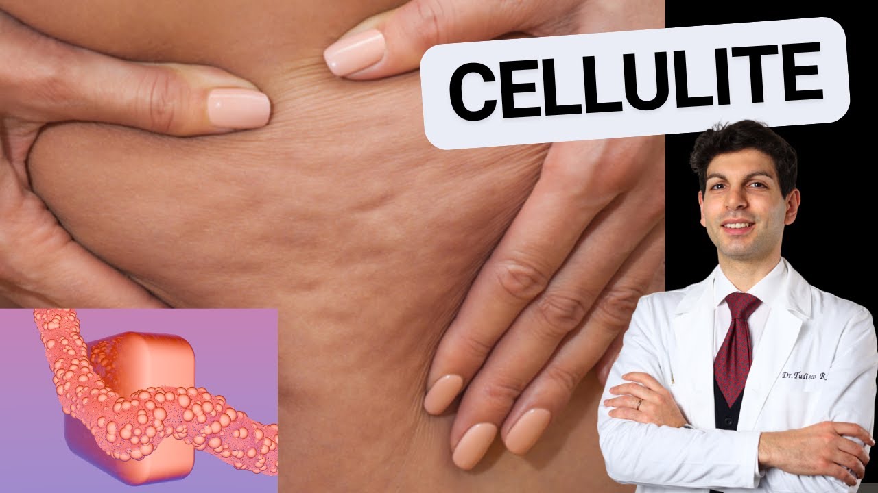 CELLULITE: come devi mangiare
