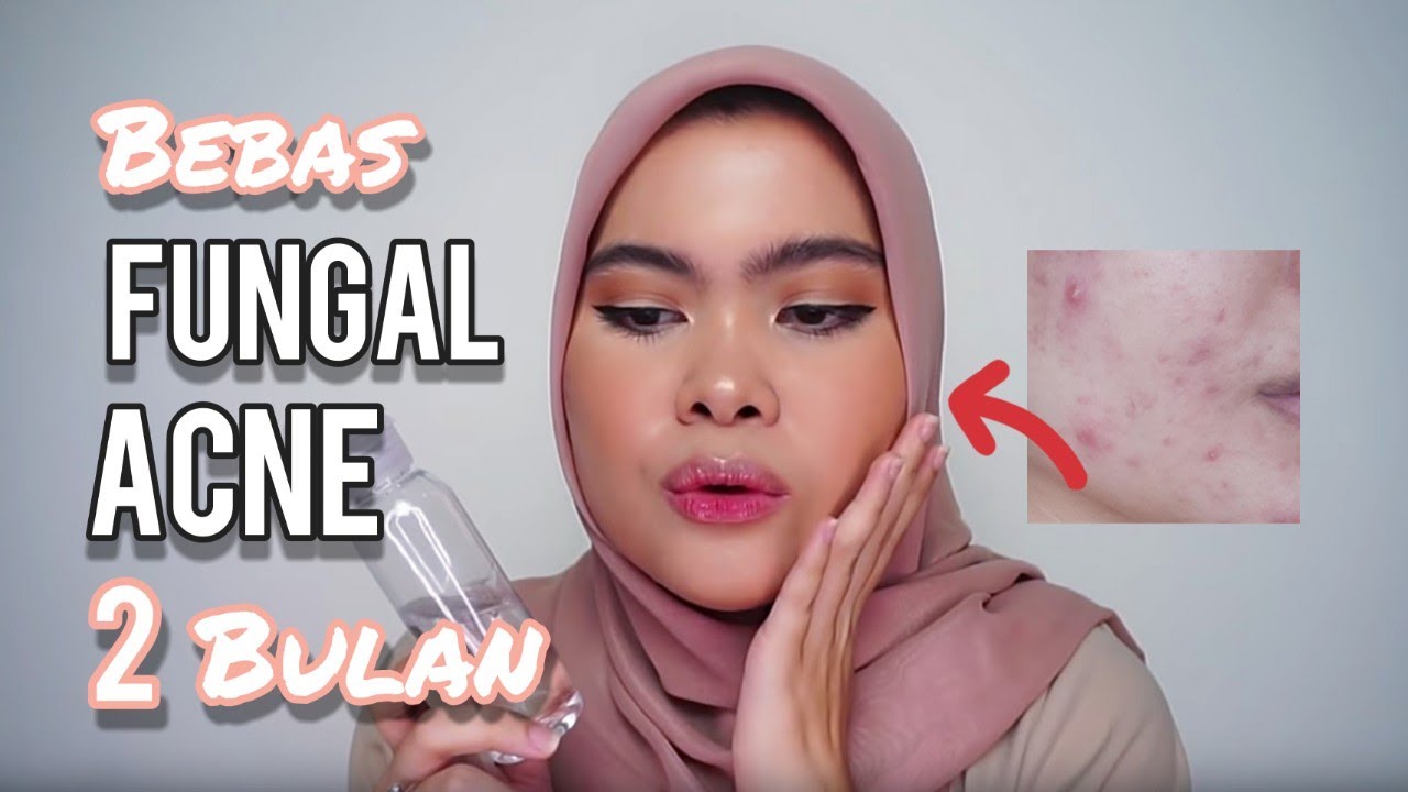 Skincare Routine: Jerawat dan Fungal Acne