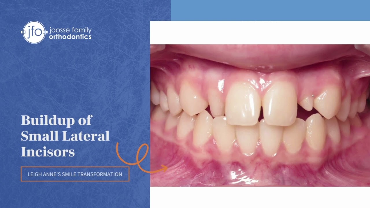 Buildup of Small Lateral Incisors | Orthodontic & Dental Collaboration | Joosse Family Orthodontics