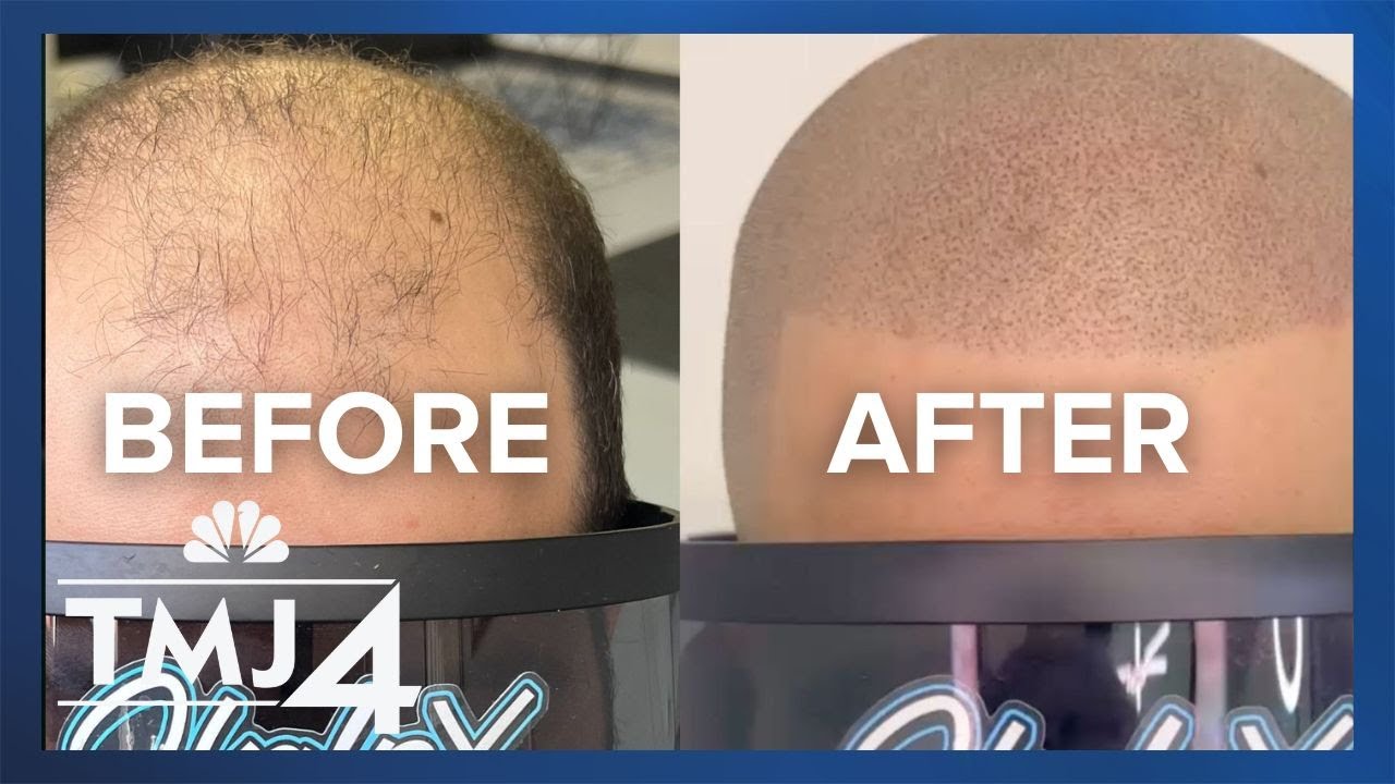 Shaving hair off and tattooing it back on