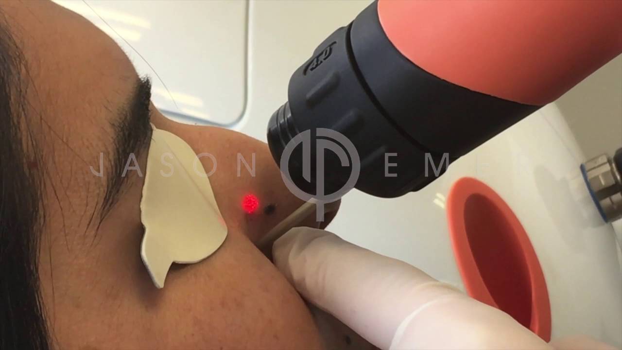 Watch Her Getting Laser Mole Removal on Nose by Dr. Jason Emer | Mole Removal Beverly Hills