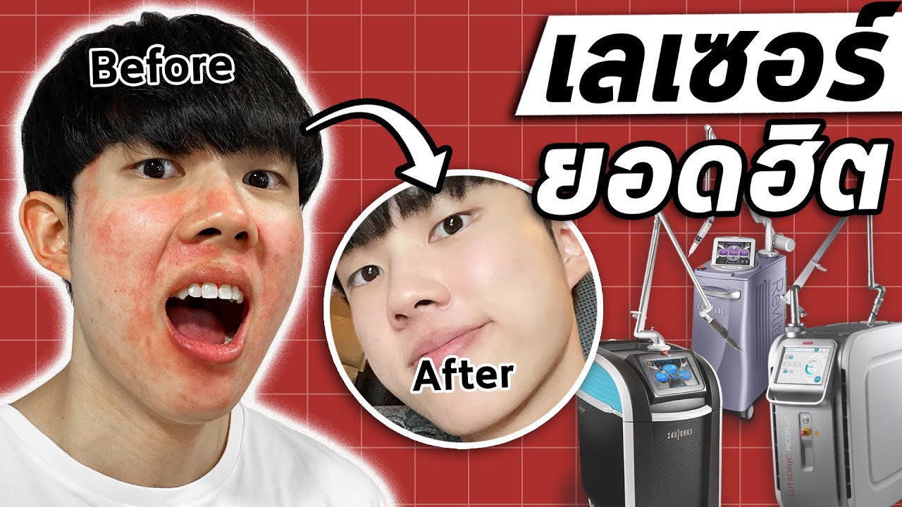 ศึกเลเซอร์ดังรักษารอยสิว หลุมสิว ริ้วรอย: ได้ผลจริงไหม ตัวไหนน่าลองสุด?! [ENG SUB]