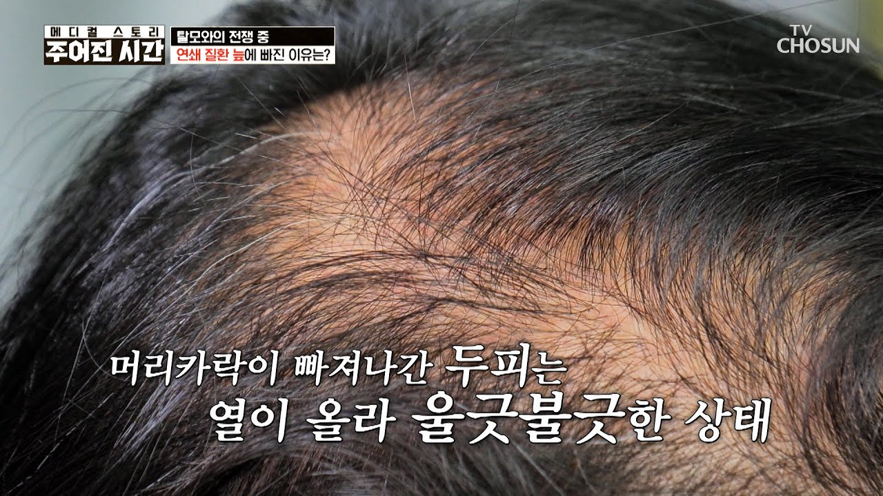 가발 없이 살아갈 수 없는 그녀의 소원은 더 이상 머리카락이 빠지지 않는 것🙏 TV CHOSUN 260221 방송 | [메디컬 스토리 주어진 시간] 2회 | TV조선
