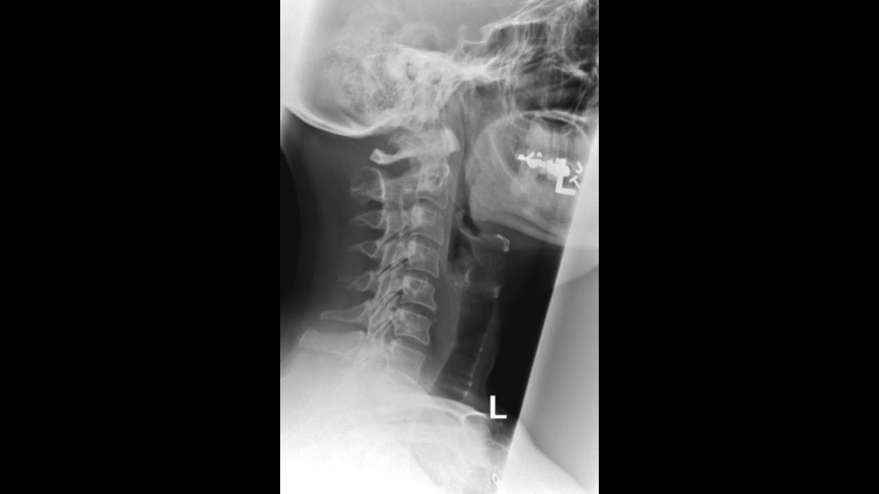 Image Analysis Lateral C spine