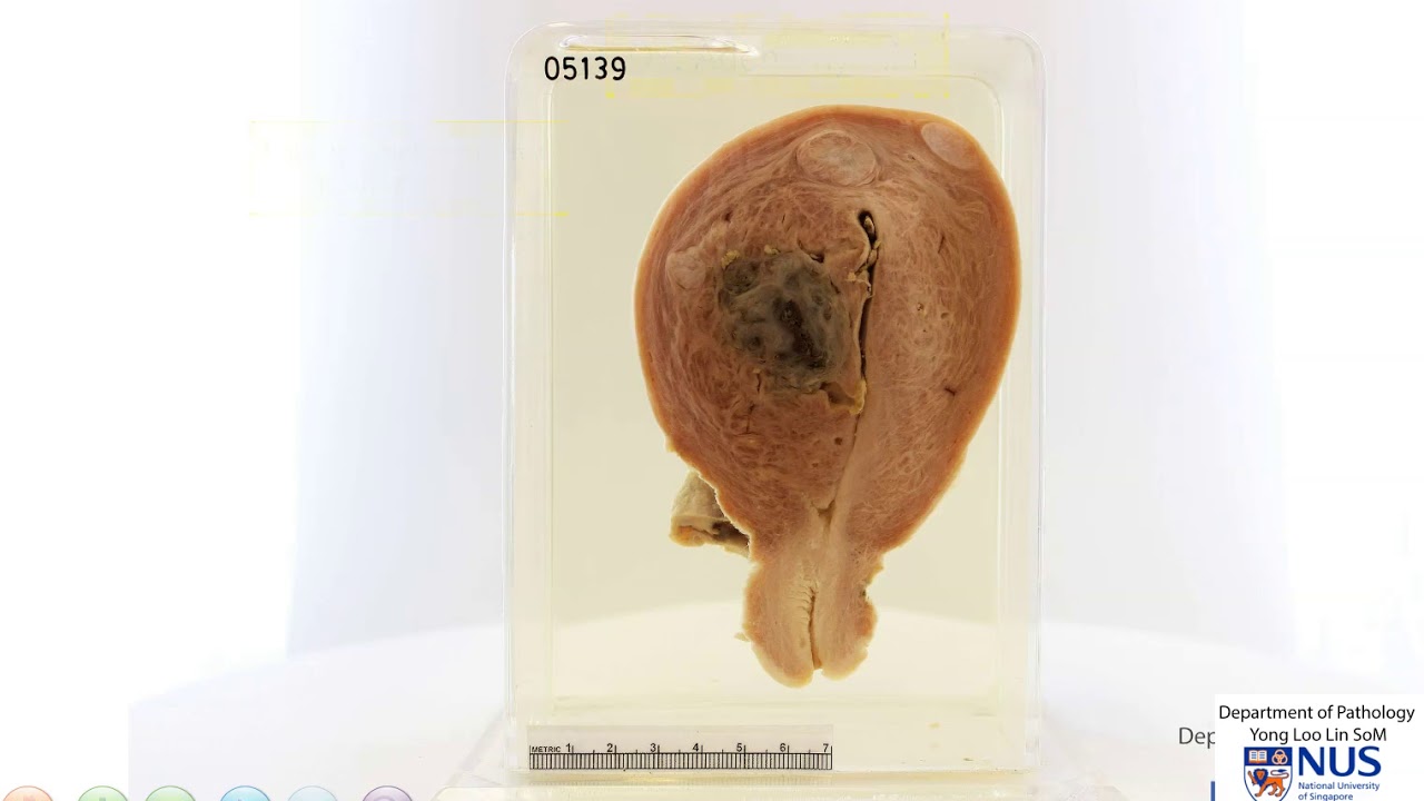 Uterus - Adenomyosis