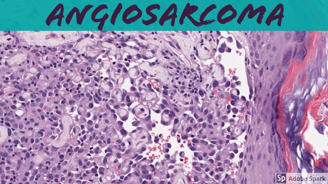 Angiosarcoma: 5-Minute Pathology Pearls