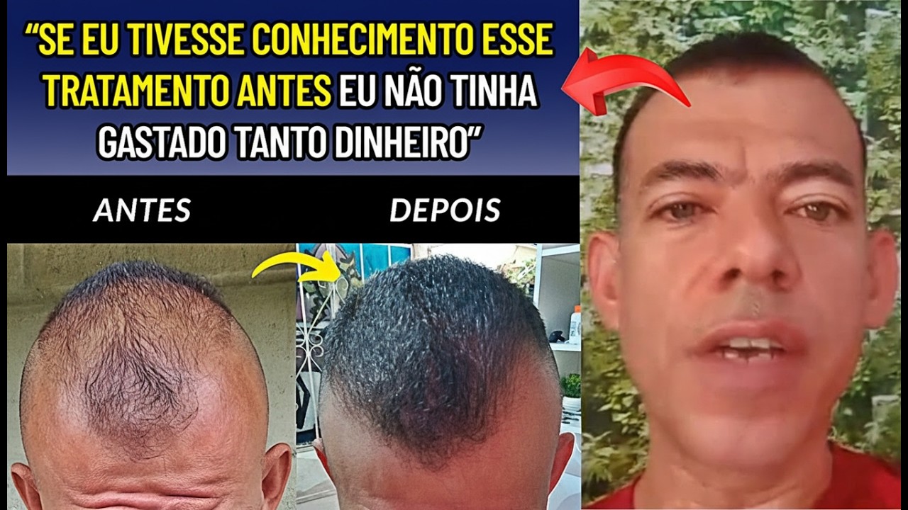 Aos 43 Anos Ele Venceu a Calvície — Veja Essa Transformação