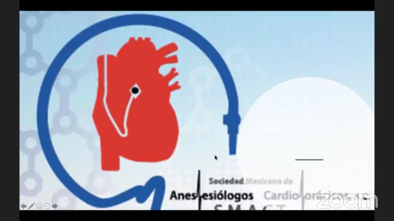 Infarto perioperatorio en Anestesia. ClasesSmact5.