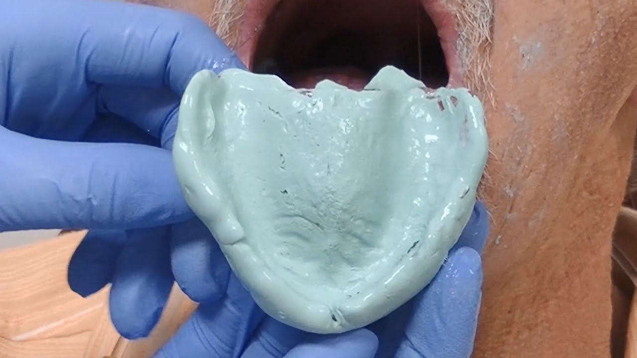 Applying a Radiopaque PVS Liner & CBCT Analysis for Guided Surgery