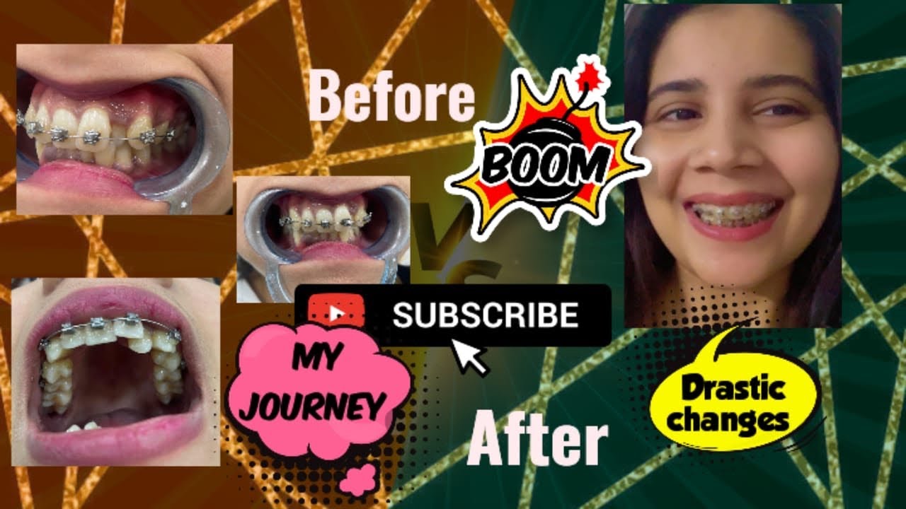 My 1 year braces journey pain/Cost/time/teeth extraction 🥳🦷🩺 #teeth #trending #youtube #viral