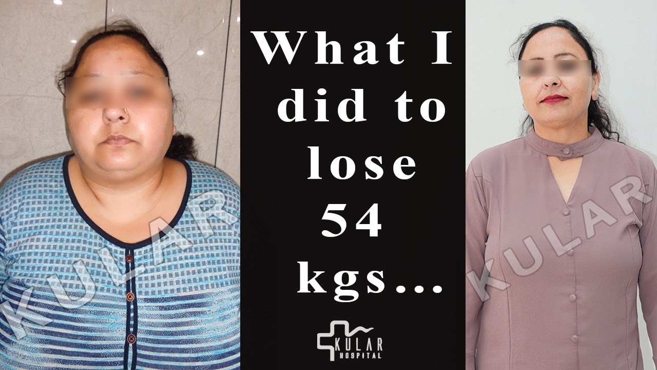 My Journey from OBESE to BEAUTIFUL| Lost 54 Kgs with Mini Gastric Bypass Surgery| Kular Bariatrics