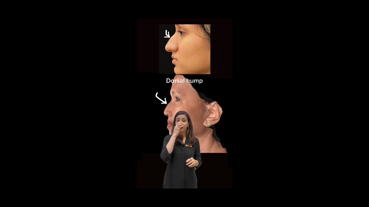 Non-surgical Rhinoplasty