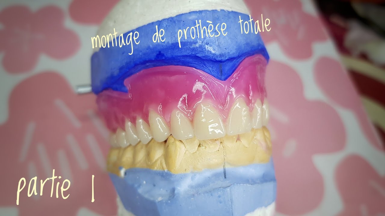 montage de prothèse totale sup partie 1 (block antérieur)