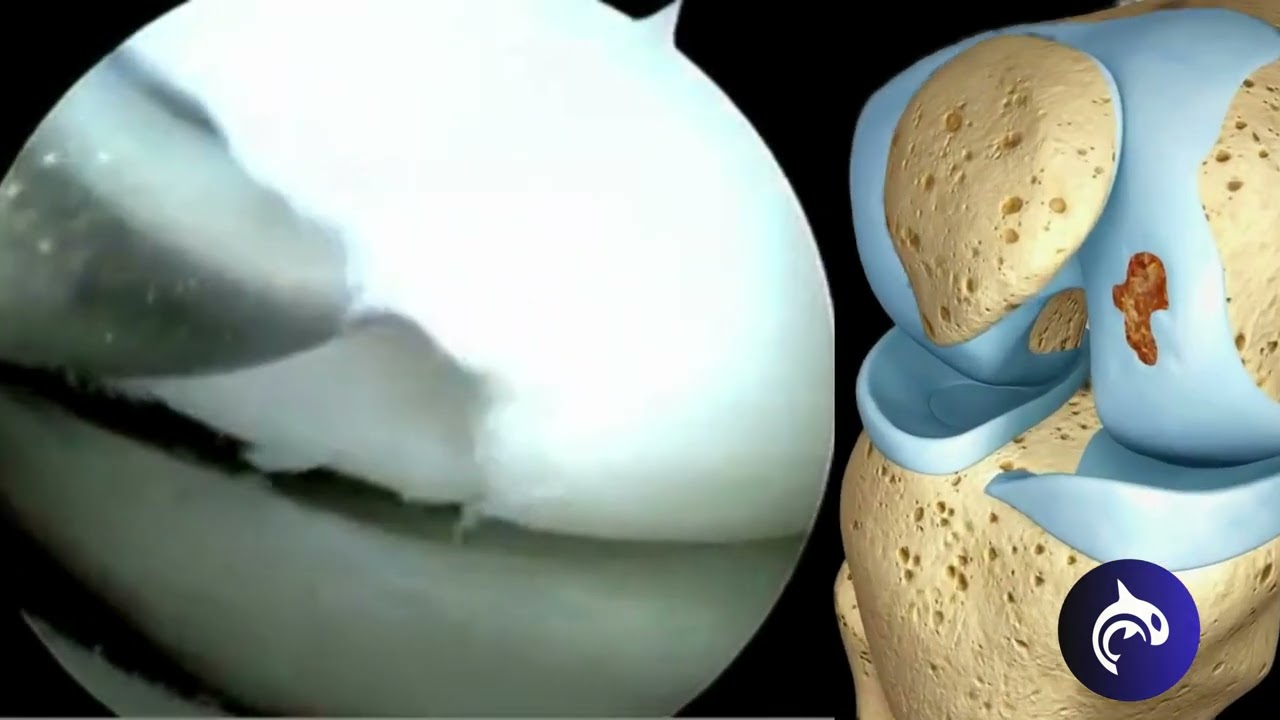 Watch an Orthopedic Surgeon treat Chondral Lesions with Microfracture Surgery