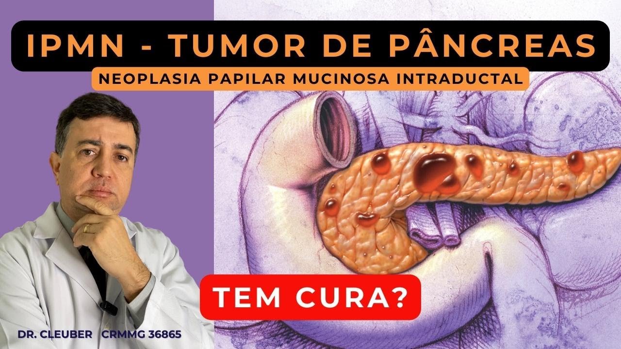 IPMN - TUMOR DE PÂNCREAS - Diagnóstico e Cura  🦠