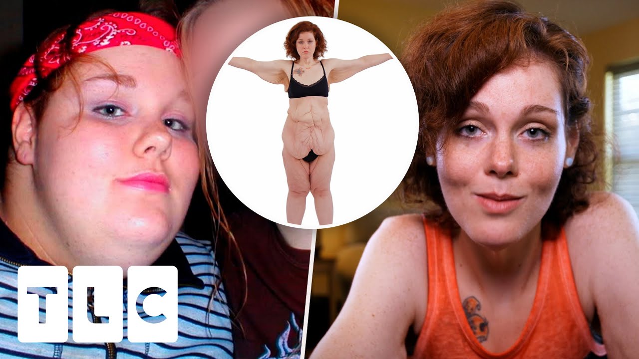 Mother Loses 339 Lb To Make Her Child Proud | My Extreme Excess Skin