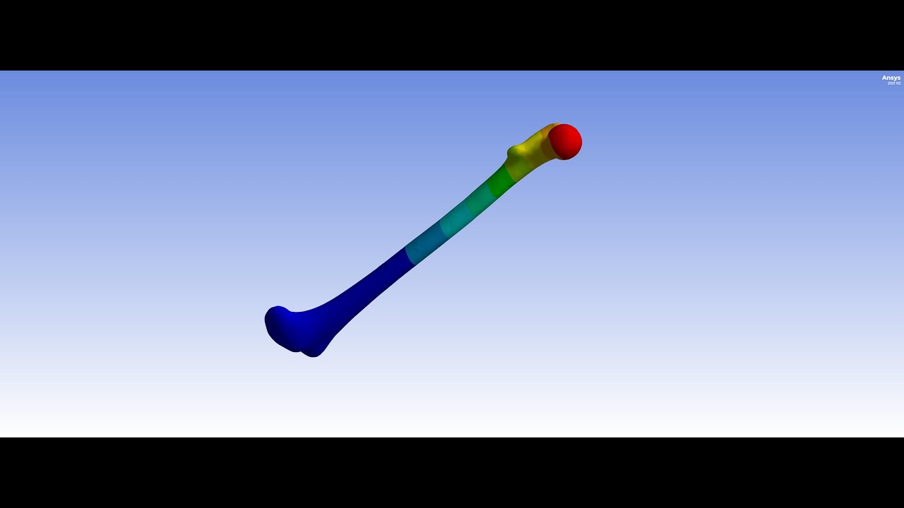 Femur Bone Structural Analysis ||  Stress & Deformation || ANSYS Workbench