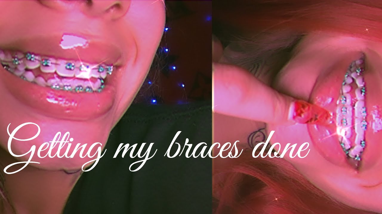 BRACE FACE GANGG🧚🏼‍♀️🦷 (watch me get braces)