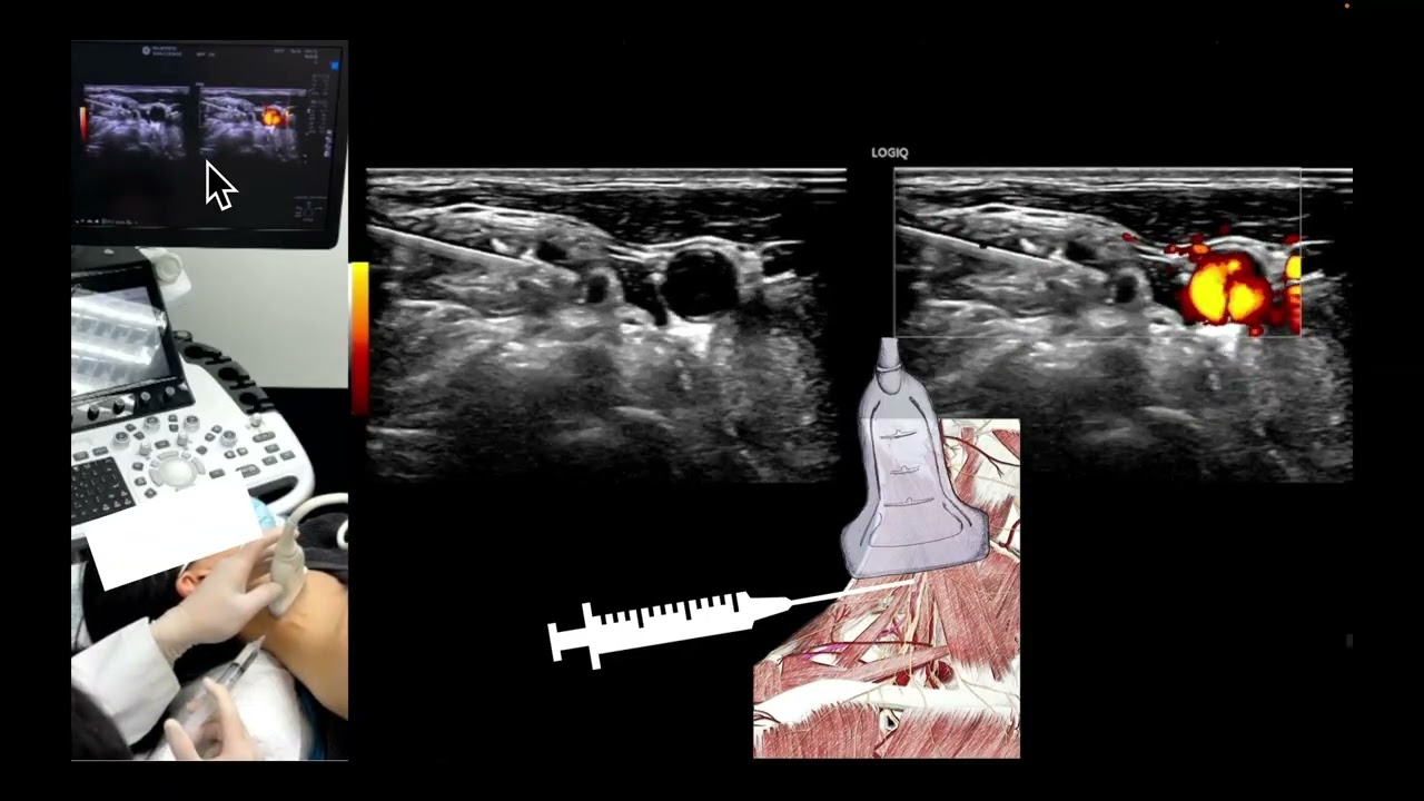 Scalene versus Scapular Approach in Dorsal Nerve Entrapment – Video S1 [576439]